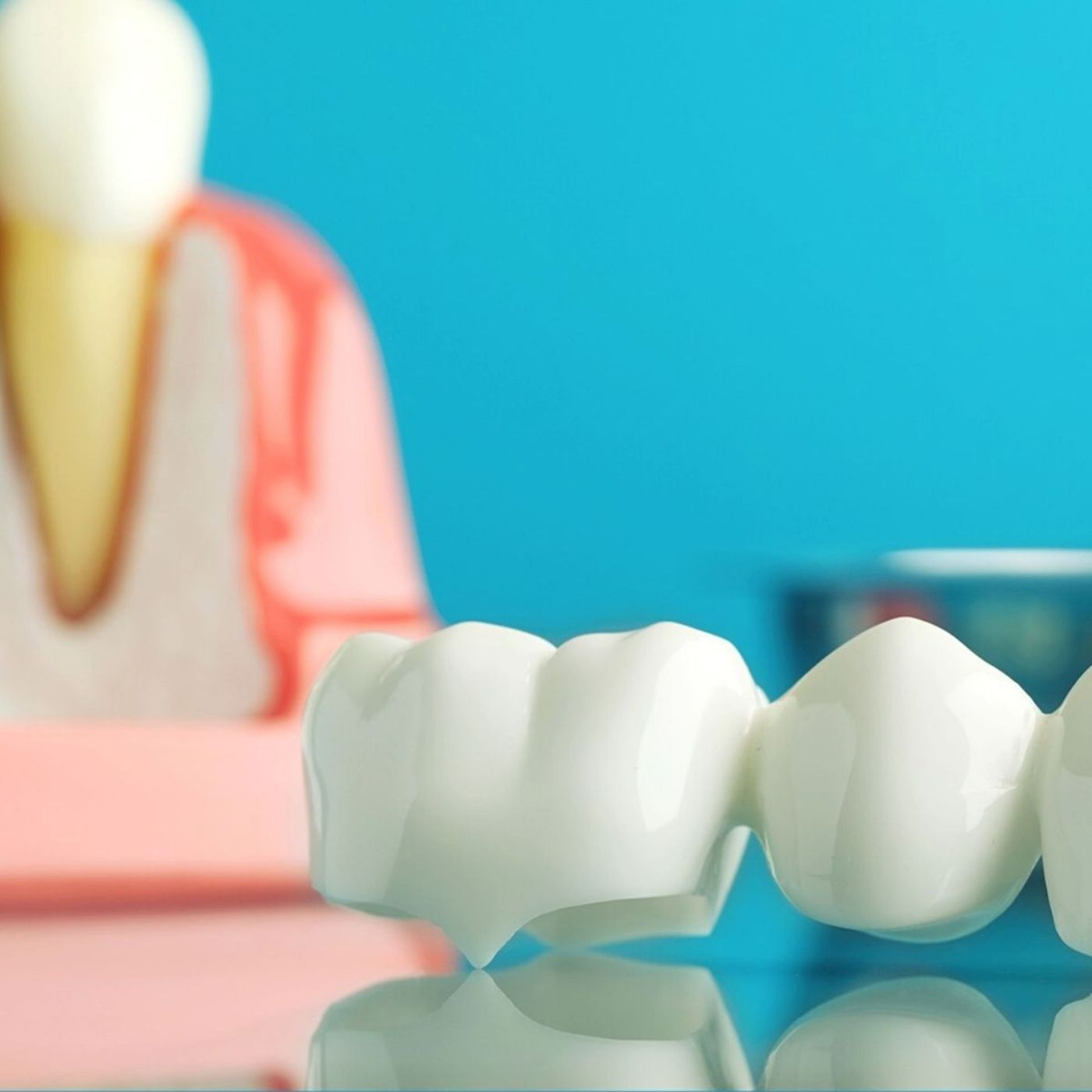 Implants and restorations